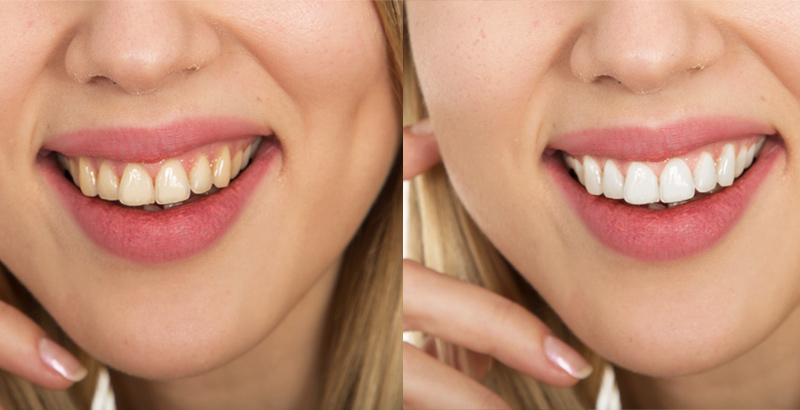 5 Steps for Whiten Teeth in Photoshop
