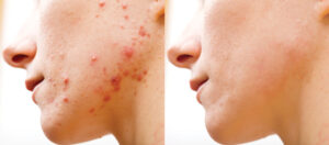 How to Remove Acne in Photoshop